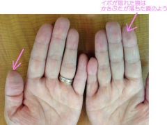 気になるイボがきれいに!